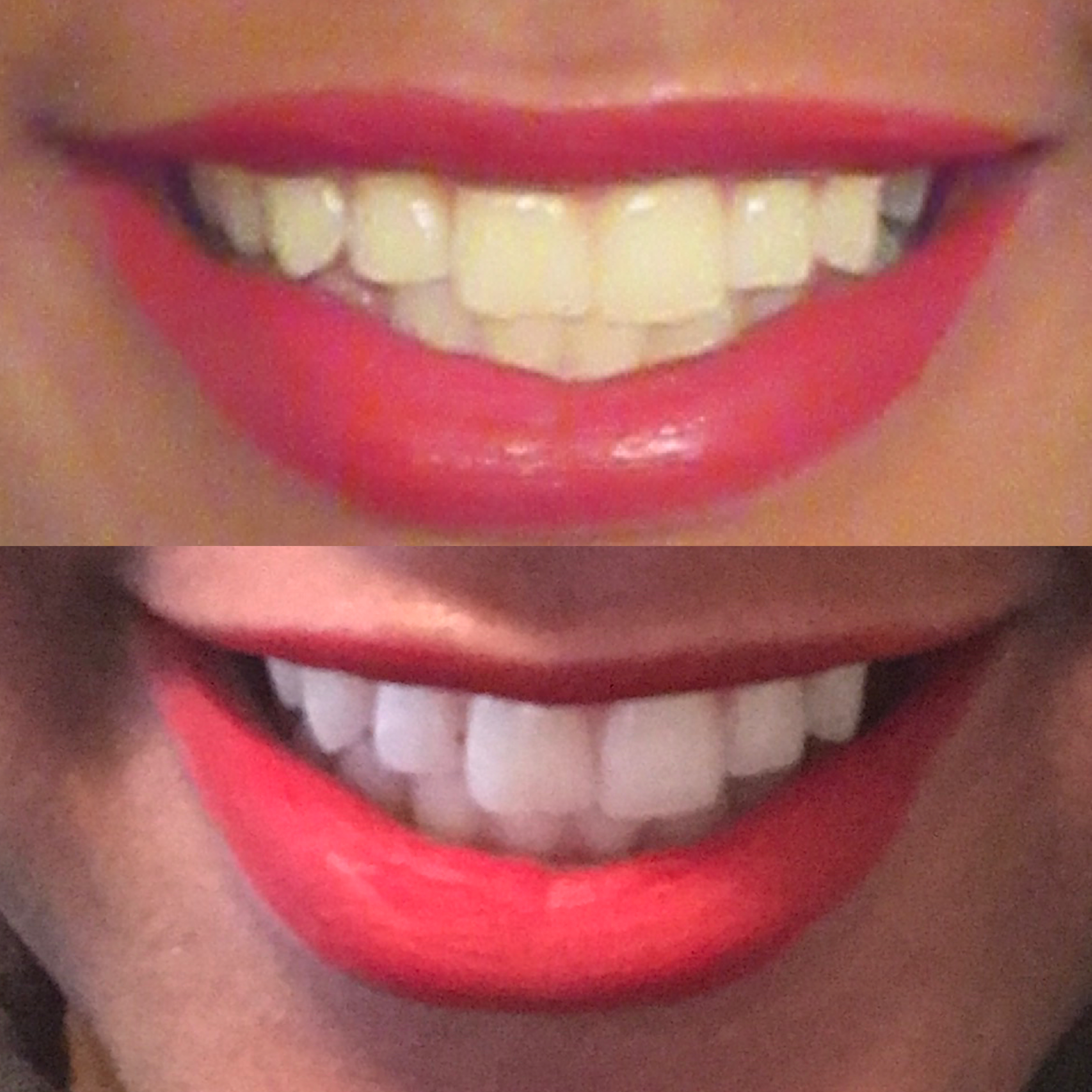 before and after teeth whitening pictures, Teeth Whitening Giveaway, custom fitted teeth whitening trays, Sensitive teeth, tooth desensitizing gel ingredients, Teeth sensitivity, teeth whitener, teeth whitening kit, coffee stained teeth, does coffee stain your teeth, how to remove stains from teeth, professional teeth whitening, custom teeth whitening trays, dentist teeth whitening, whitening teeth at home, home teeth whitening, teeth whitening tray, teeth whitening gel, tobacco stains,